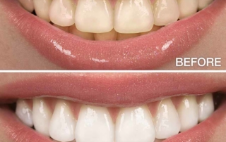 whitened teeth tips