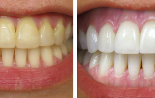coffee stained teeth
