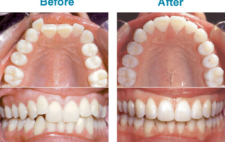 before and after invisalign