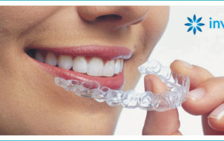 invisalign