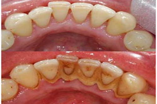 before after teeth cleaning