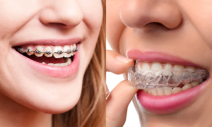 invisalign clear aligners vs braces