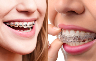 invisalign clear aligners vs braces