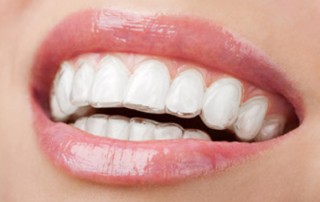 invisalign