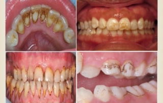 Teeth discoloration