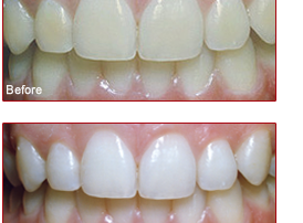 professional teeth whitening