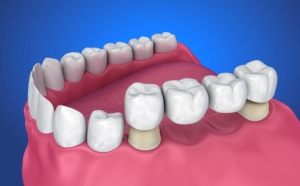 Dental Bridges at Monroe Family Dentistry