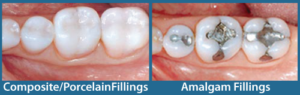 tooth filling options