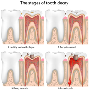 Tooth decay