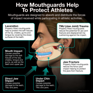 protecting athletes with mouthguards