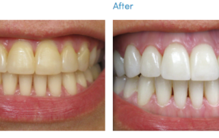 teeth whitening monroe nc