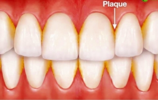 Plaque buildup removal monroe nc