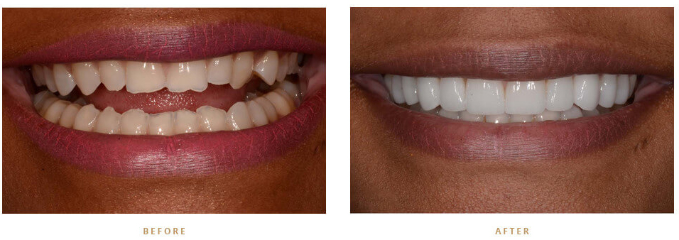Permanently whiten teeth monroe nc dentist