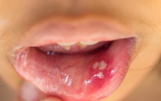 hpv throat and mouth cancer