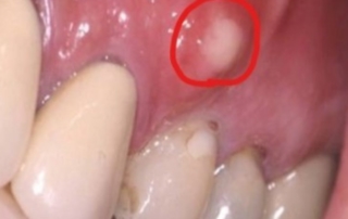 Abscess Tooth symptoms