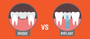 Dental Bridge Vs Implant | Monroe Family Dentistry