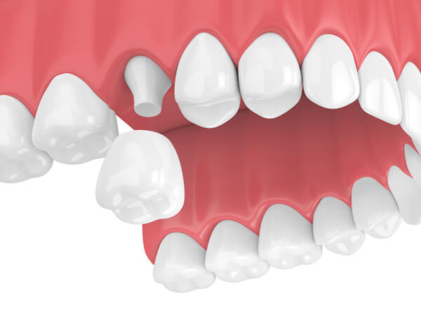Dental Crowns - Monroe Family Dentistry