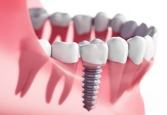 Dental Implant Options